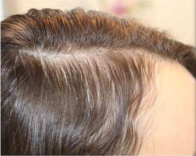 Hair Restoration with Exosomes Gallery - Patient 122660441 - Image 1