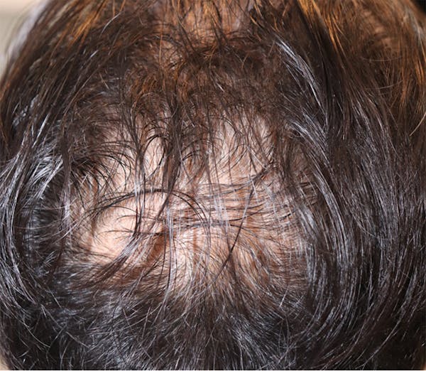 Hair Restoration with Exosomes Before & After Gallery - Patient 122660440 - Image 3