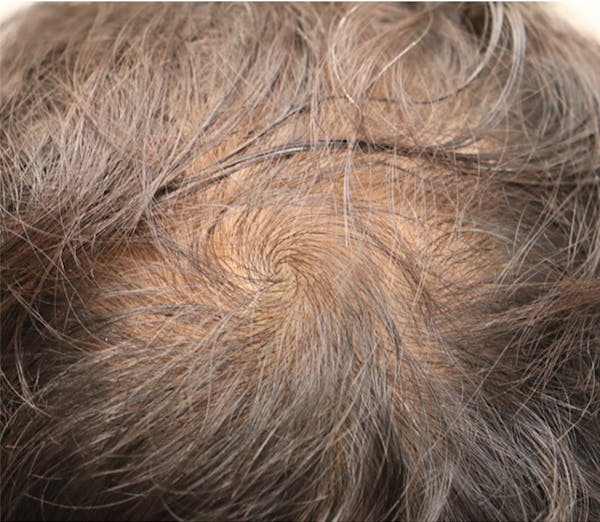 Hair Restoration with Exosomes Gallery - Patient 122660440 - Image 4