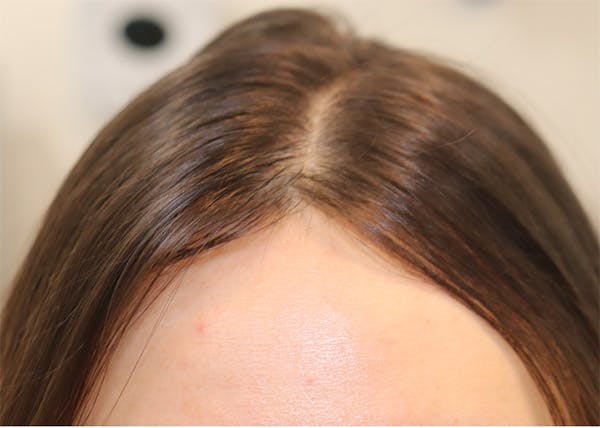 Hair Restoration with Exosomes Before & After Gallery - Patient 122660441 - Image 7
