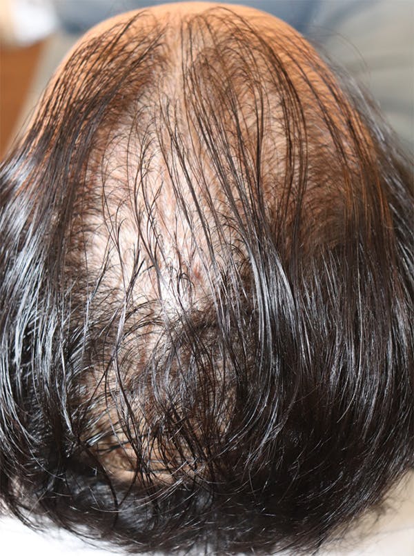 Hair Restoration with Exosomes Gallery - Patient 122660440 - Image 1