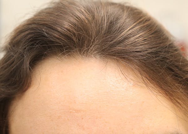 Hair Restoration with Exosomes Before & After Gallery - Patient 122660441 - Image 8