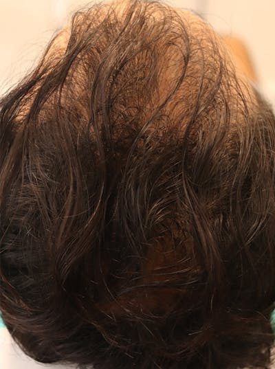 Hair Restoration with Exosomes Before & After Gallery - Patient 122660440 - Image 2