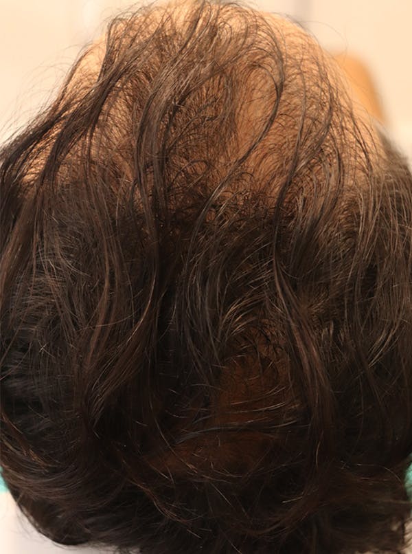 Hair Restoration with Exosomes Before & After Gallery - Patient 122660440 - Image 2