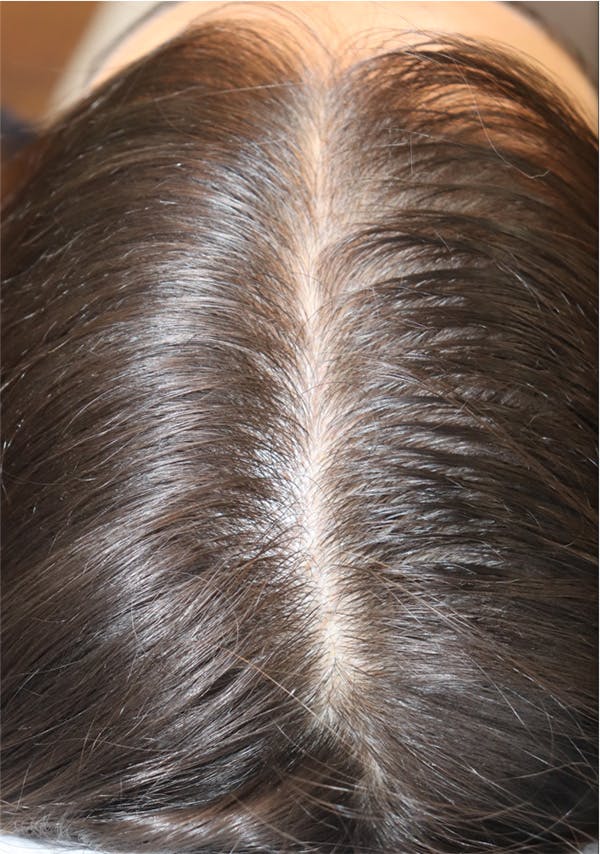 Hair Restoration with Exosomes Before & After Gallery - Patient 122660441 - Image 3