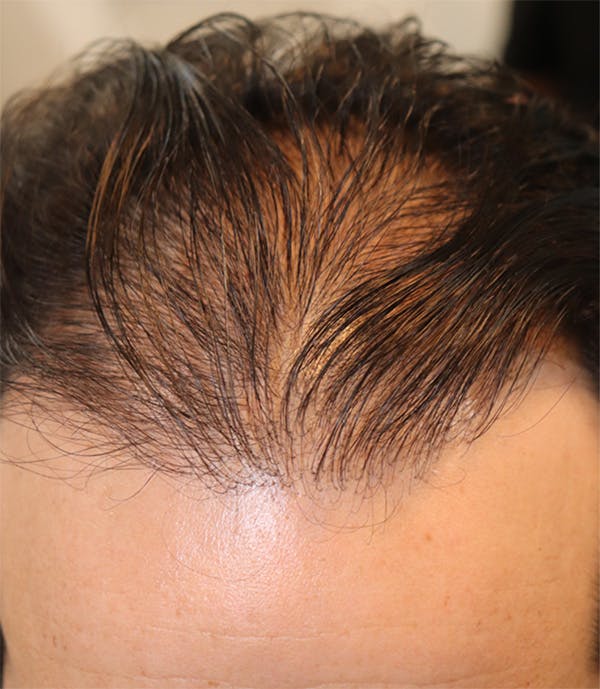 Hair Restoration with Exosomes Before & After Gallery - Patient 122660440 - Image 7