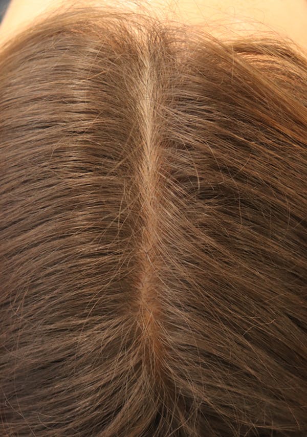 Hair Restoration with Exosomes Before & After Gallery - Patient 122660441 - Image 4