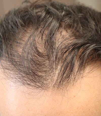 Hair Restoration with Exosomes Before & After Gallery - Patient 122660440 - Image 8
