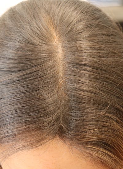 Hair Restoration with Exosomes Before & After Gallery - Patient 122660441 - Image 10