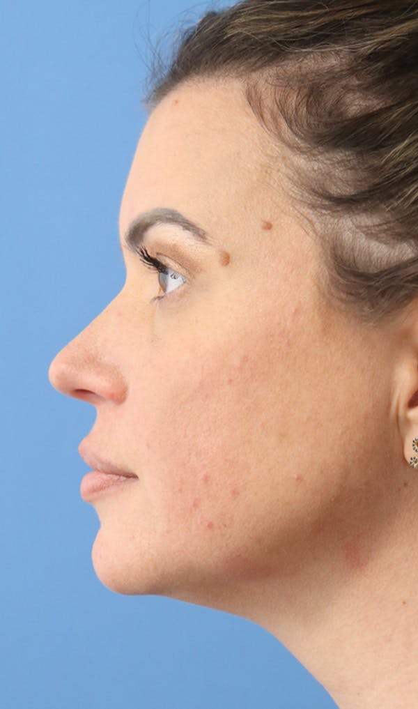 Jawline & Neck Filler Before & After Gallery - Patient 144976915 - Image 3