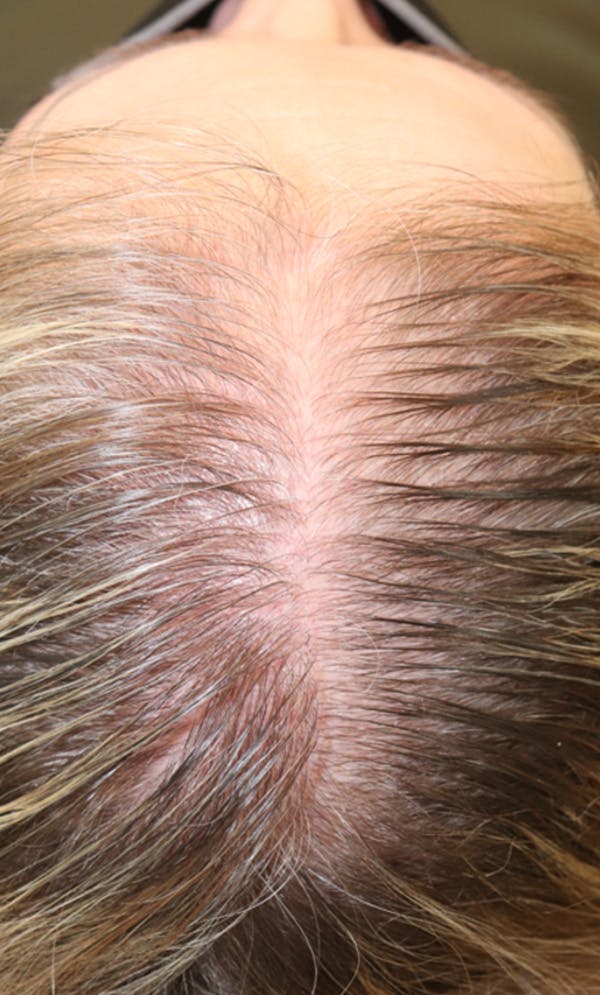 Hair Restoration with Exosomes Before & After Gallery - Patient 122660439 - Image 1