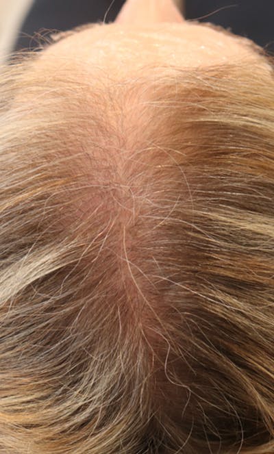 Hair Restoration with Exosomes Gallery - Patient 122660439 - Image 2