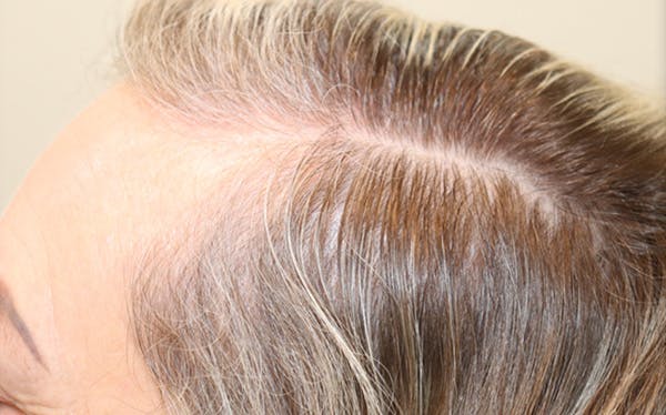Hair Restoration with Exosomes Before & After Gallery - Patient 122660439 - Image 3
