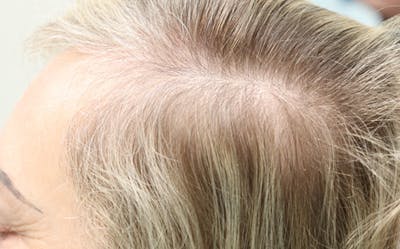 Hair Restoration with Exosomes Gallery - Patient 122660439 - Image 4