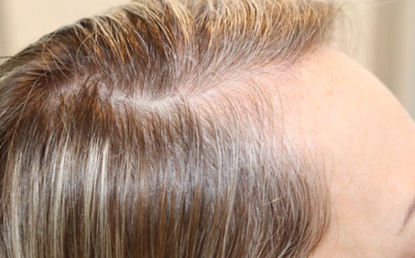 Hair Restoration with Exosomes Before & After Gallery - Patient 122660439 - Image 5