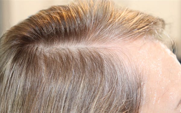 Hair Restoration with Exosomes Gallery - Patient 122660439 - Image 6