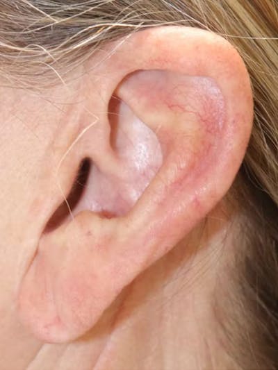 Earlobe Repair Before & After Gallery - Patient 123127694 - Image 1