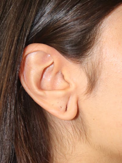 Earlobe Reduction Gallery - Patient 123127695 - Image 1