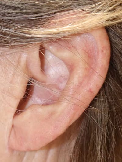 Earlobe Reduction Gallery - Patient 123127694 - Image 2