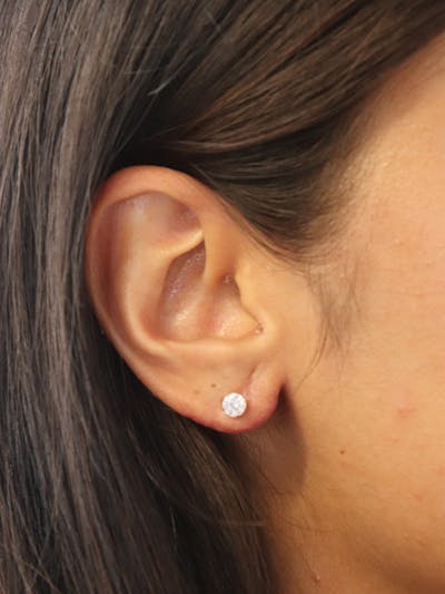 Earlobe Repair Before & After Gallery - Patient 123127695 - Image 2