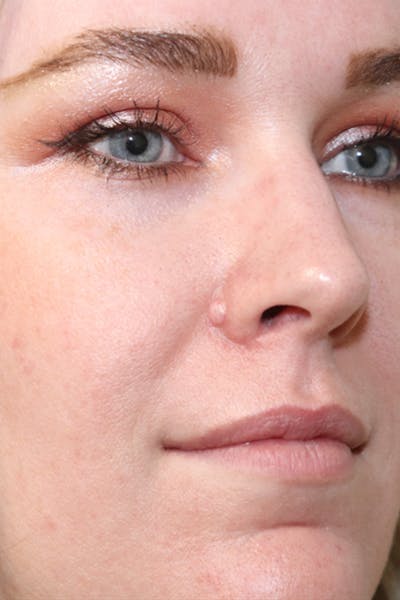 Mole Removal Before & After Gallery - Patient 123128089 - Image 1