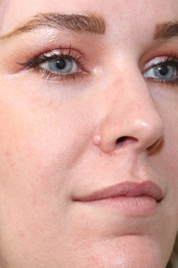 Mole Removal Before & After Gallery - Patient 123128089 - Image 1