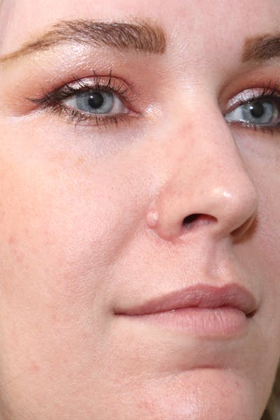 Blemish & Mole Removal Gallery - Patient 123128089 - Image 1