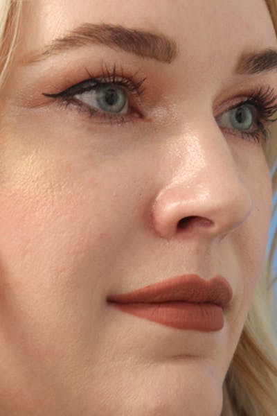 Mole Removal Before & After Gallery - Patient 123128089 - Image 2