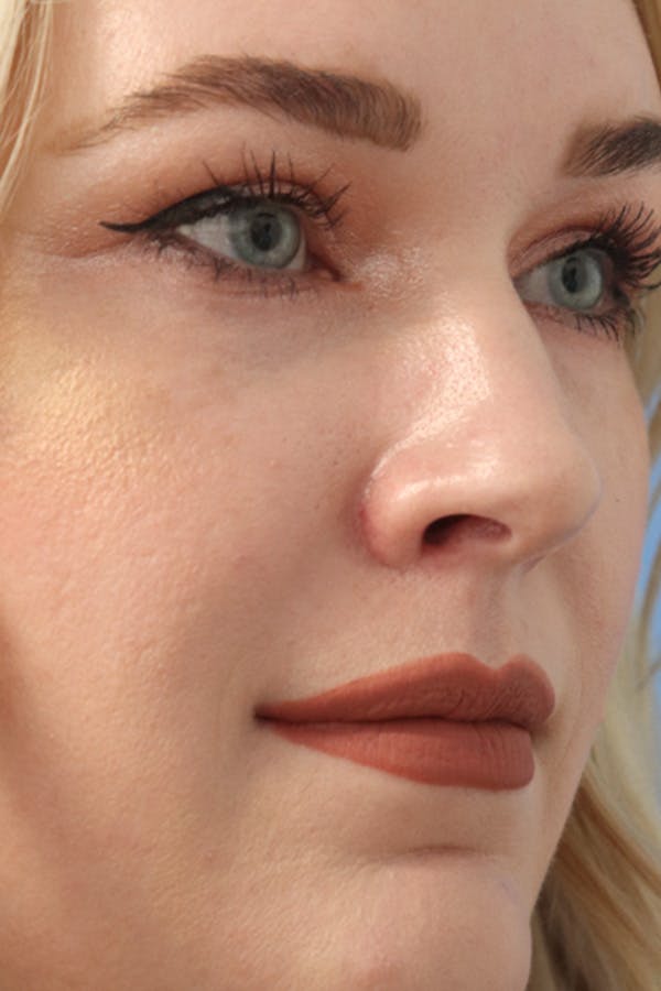 Mole Removal Before & After Gallery - Patient 123128089 - Image 2