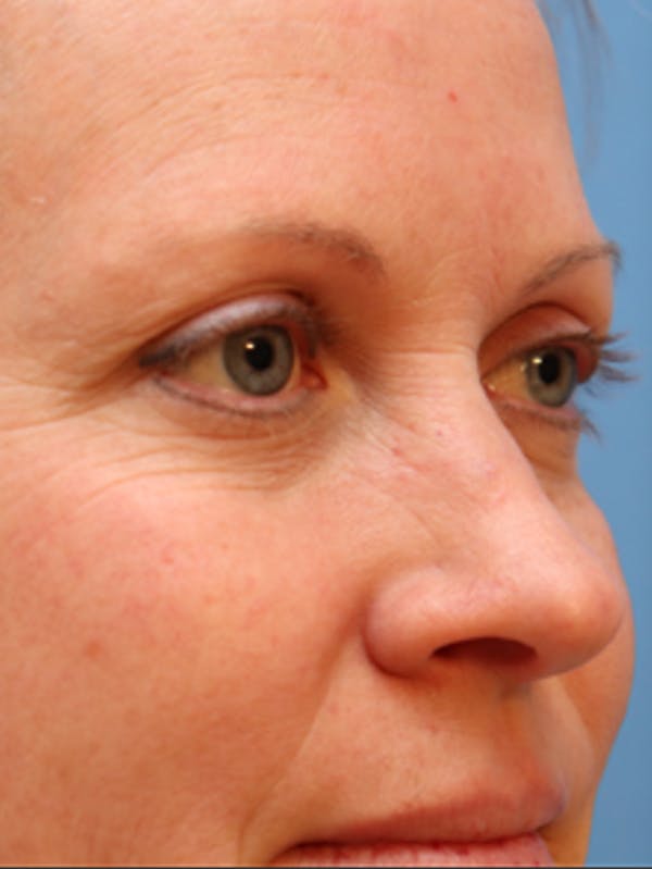 Cheek & Under Eye Filler Before & After Gallery - Patient 145843861 - Image 5