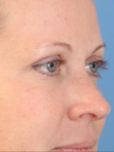 Cheek & Under Eye Filler Before & After Gallery - Patient 145843861 - Image 6