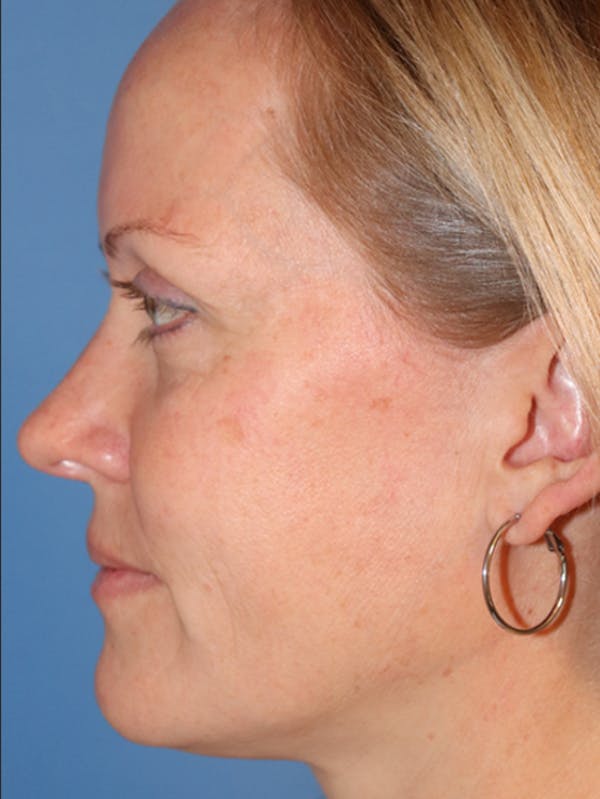 Cheek & Under Eye Filler Before & After Gallery - Patient 145843861 - Image 3