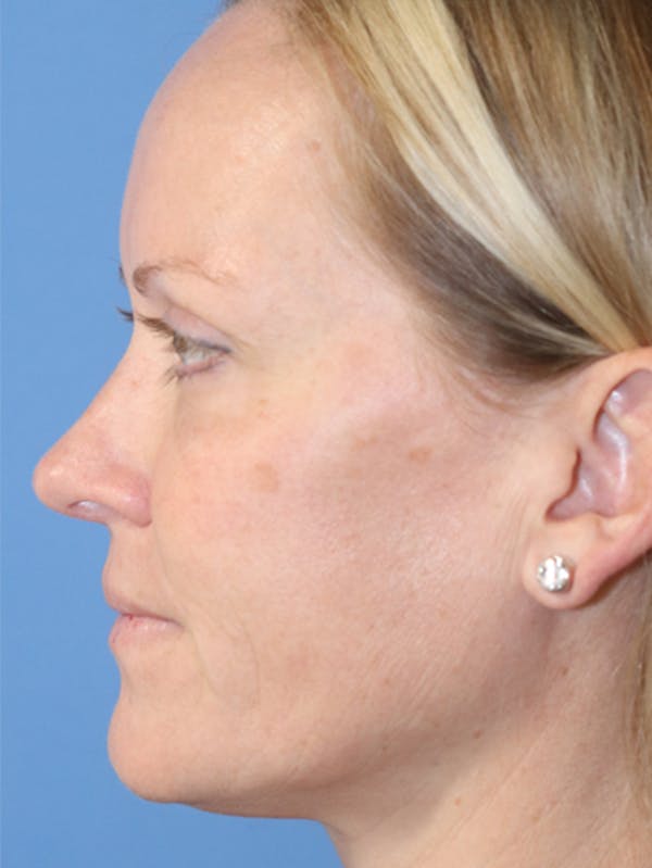 Cheek & Under Eye Filler Before & After Gallery - Patient 145843861 - Image 4