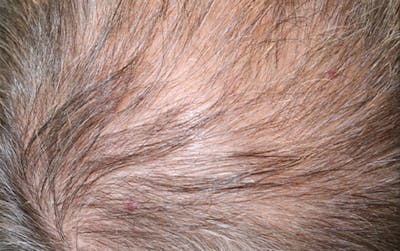 Hair Restoration with Exosomes Gallery - Patient 141597297 - Image 1
