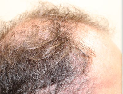 Hair Restoration with Exosomes Before & After Gallery - Patient 37796886 - Image 1