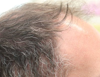 Hair Restoration with Exosomes Before & After Gallery - Patient 37796886 - Image 2