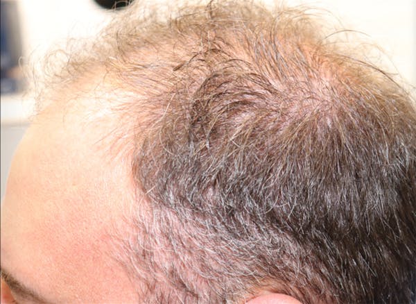 Hair Restoration with Exosomes Before & After Gallery - Patient 37796886 - Image 3