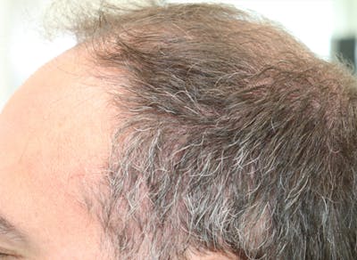 Hair Restoration with Exosomes Before & After Gallery - Patient 37796886 - Image 4