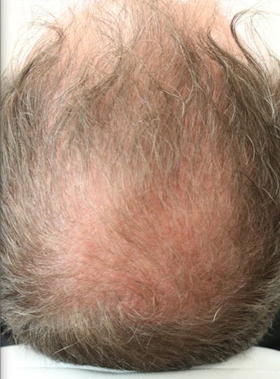 Hair Restoration with Exosomes Before & After Gallery - Patient 37796886 - Image 6