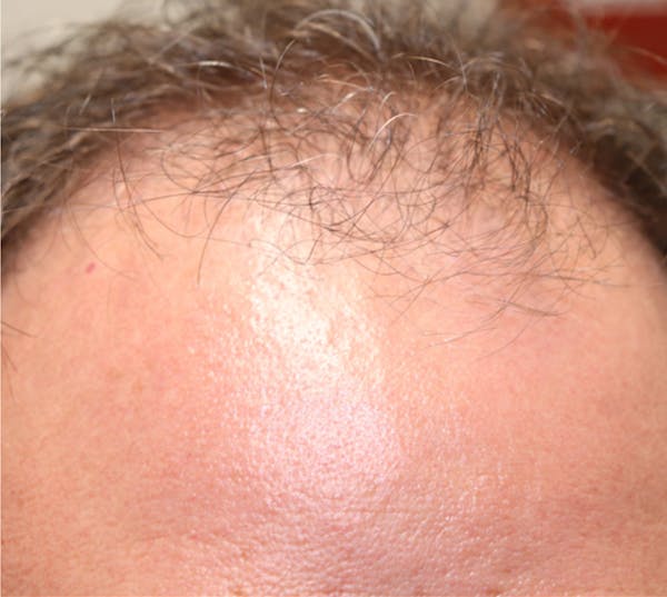 Hair Restoration with Exosomes Before & After Gallery - Patient 37796886 - Image 7
