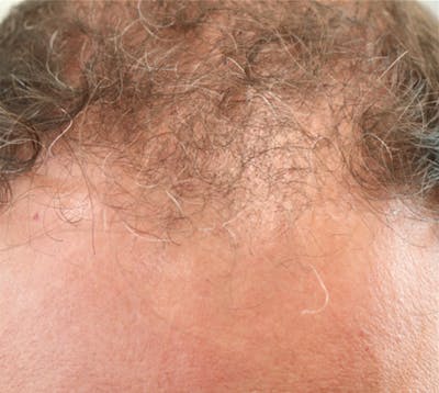 Hair Restoration with Exosomes Before & After Gallery - Patient 37796886 - Image 8