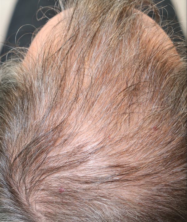 Hair Restoration with Exosomes Before & After Gallery - Patient 141597297 - Image 1
