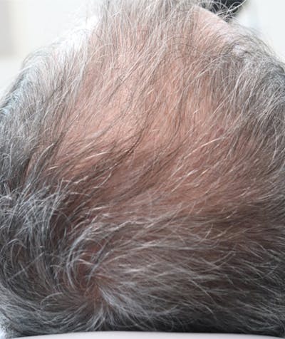 Hair Restoration with Exosomes Before & After Gallery - Patient 141597297 - Image 2
