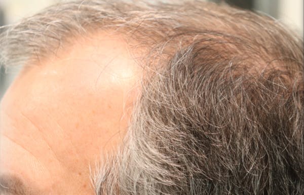 Hair Restoration with Exosomes Before & After Gallery - Patient 141597297 - Image 3