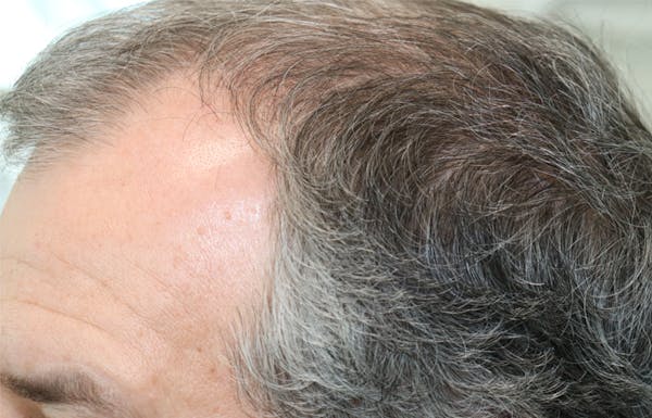 Hair Restoration with Exosomes Before & After Gallery - Patient 141597297 - Image 4