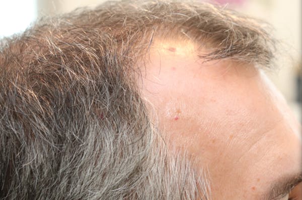 Hair Restoration with Exosomes Before & After Gallery - Patient 141597297 - Image 5