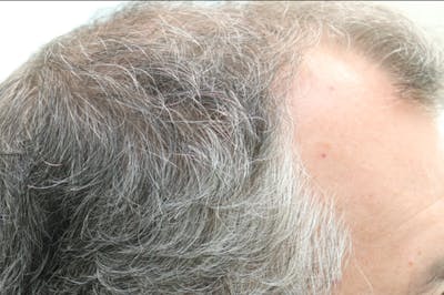 Hair Restoration with Exosomes Before & After Gallery - Patient 141597297 - Image 6
