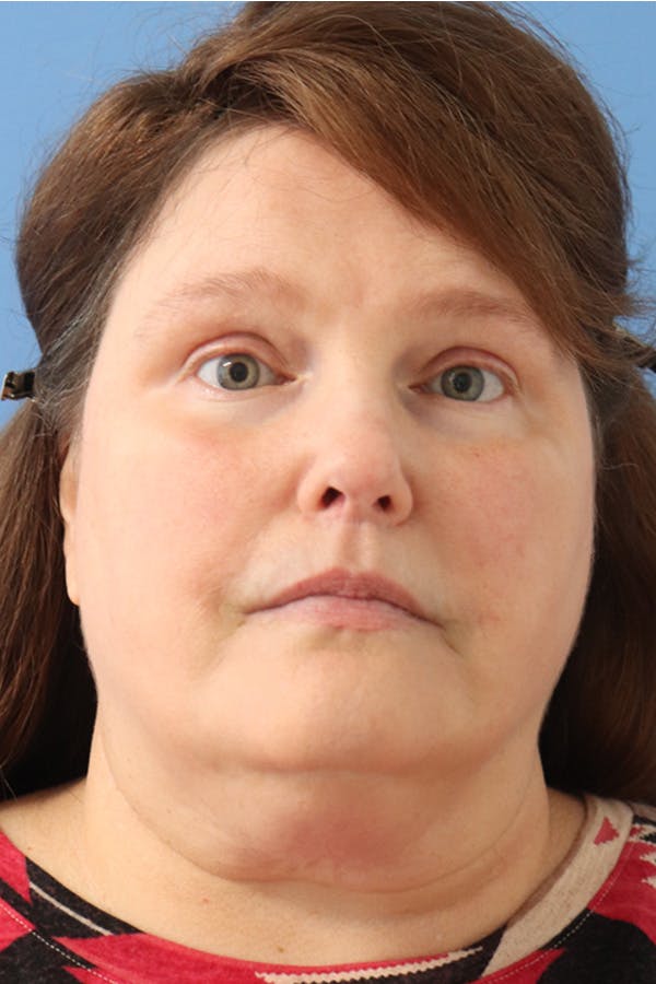 Brow Lift Before & After Gallery - Patient 145354773 - Image 2
