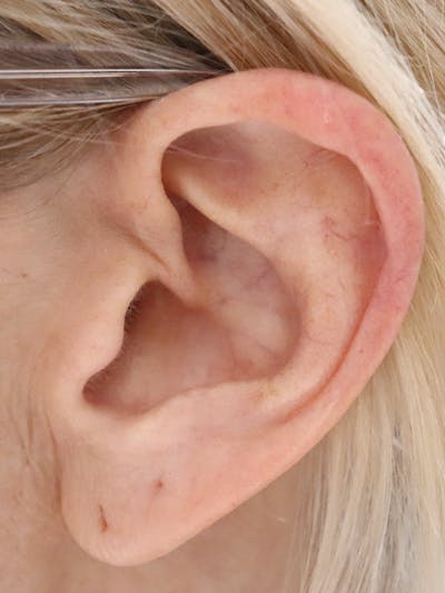 Earlobe Repair Before & After Gallery - Patient 145354784 - Image 1