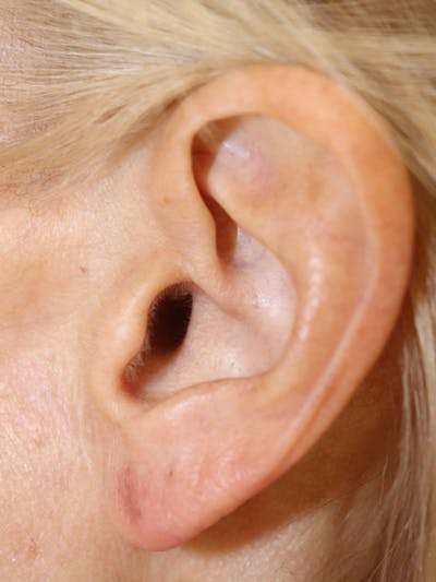 Earlobe Repair Before & After Gallery - Patient 145354784 - Image 2